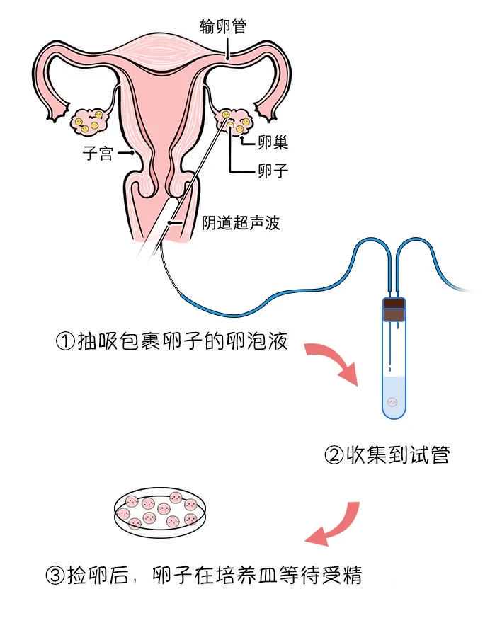 AMH值低不等于要供卵，解析卵巢储备与三代试管选择